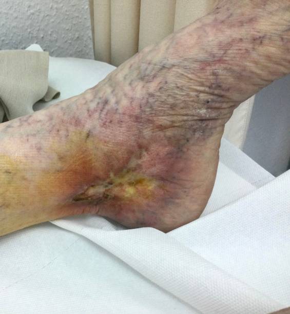 Bed Sore Treatment & Dressing